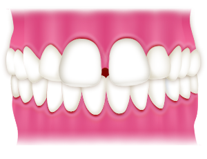 空隙歯列（前歯のすき間が広い）